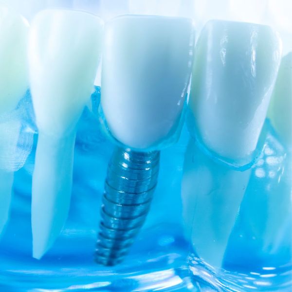 Why Dental Implants are the Best Investment for Your Smile Advanced